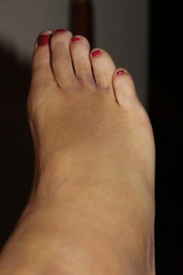 Africa foot injury, Top Airlines 1